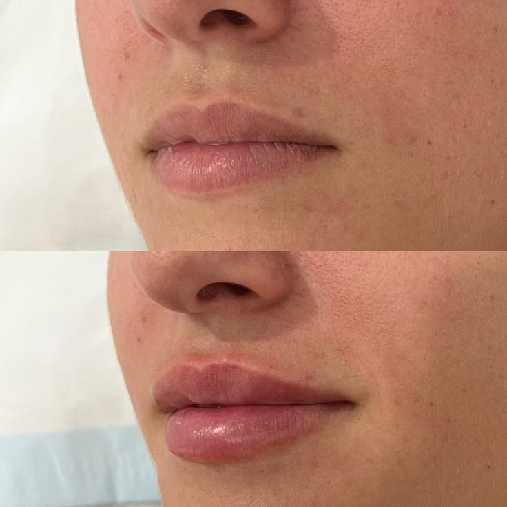 A_little_goes_a_long_way_when_it_comes_to_lip_filler__How_amazing_are_these_subtle_tweaks_for_a_full_yet_natural-looking_pout__Click_the_in_our_bio_to_book_your_lip_filler_appointment.jpg